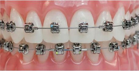 Nắn chỉnh răng 2 hàm sử dụng hệ thống mắc cài